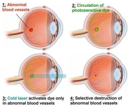 focal laser photocoagulation
