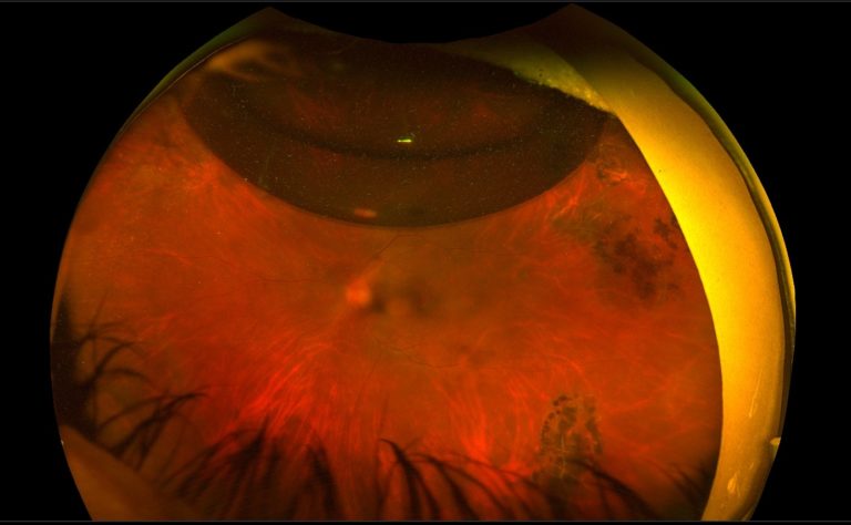 Intraocular Gases And Oil Macula Retina Vitreous Center intraocular-gases-and-oil-macula-retina-vitreous-center