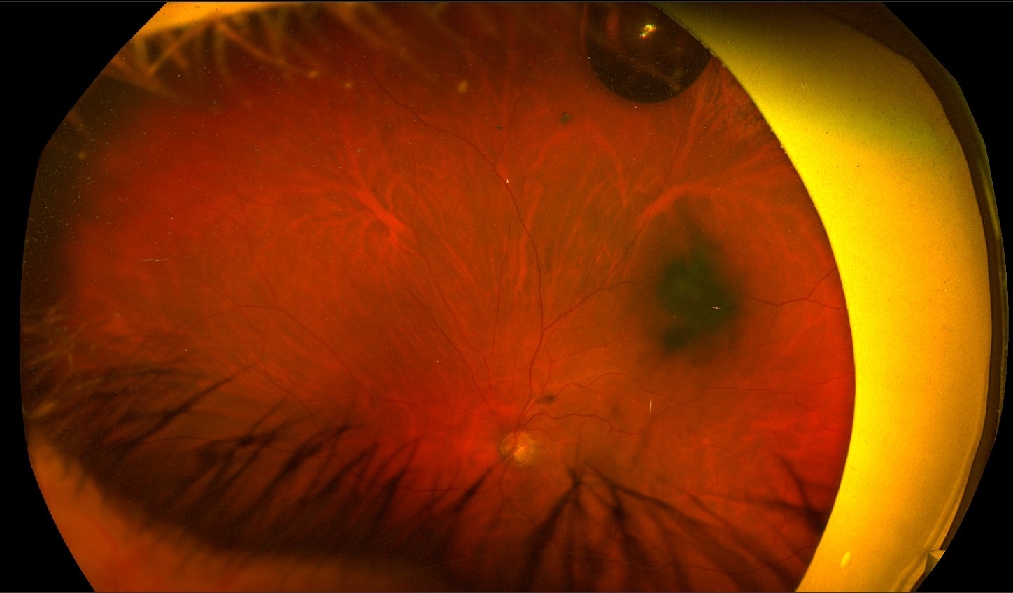 Flashes and Floaters - Macula Retina Vitreous Center