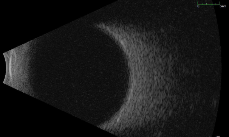 Ocular Ultrasonography – Macula Retina Vitreous Center