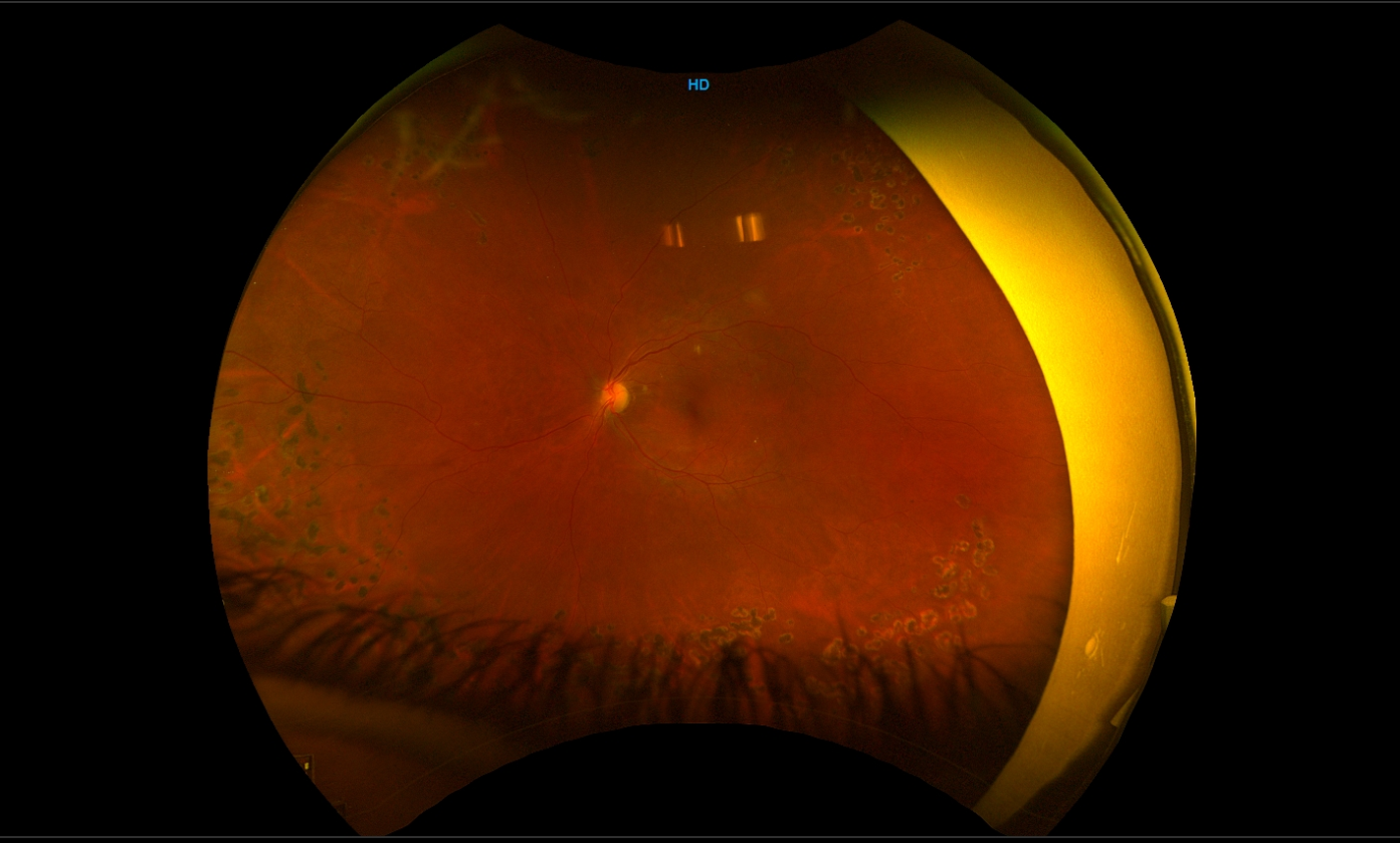 Digital Fluorescein Angiography - Macula Retina Vitreous Center