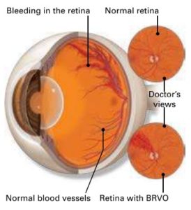 Retinal Vein Occlusion - Macula Retina Vitreous Center