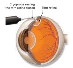 torn retina healing time